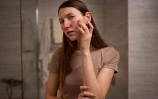 piel rosacea